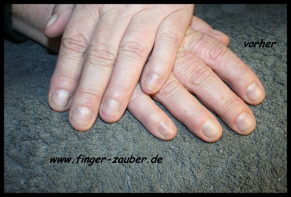 Neumodellage vorher